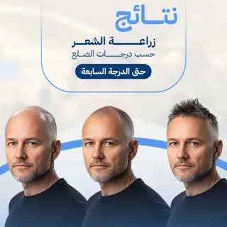 التخطيط هو سر النجاح!
كل "درجة صلع" على مقياس هاملتون 
 تحتاج استراتيجية فنية وطبية خاصة لضمان النتي