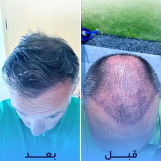 5200 بصيلة… ونتيجة تُظهر الفرق ✨

رحلة استعادة الشعر تبدأ بخطة دقيقة، 
وليس بعدد البصيلات فقط.

في ه