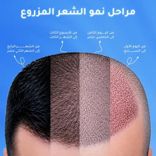 نتيجة زراعة الشعر لا تظهر بين ليلة وضحاها… بل هي رحلة تحتاج إلى وقت وصبر. ✨

بعد إجراء زراعة الشعر، 