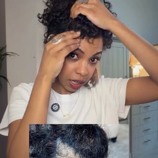 ⁨	بعد ٦ شهور من عملية زراعة الشعر 😌😌😌
 العملية كانت في مستشفى ‪@elithair.ar‬⁩