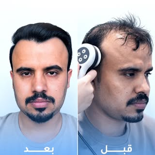 ⁨	⁨	والنتيجة الآن بعد 8 أشهر فقط!
في حالة صديقنا  @ta97riq تمّت زراعة 5500 بصيلة 
لتحقيق تغطية أفضل 