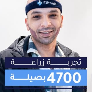 تبدأ زراعة اللحية بتقييم الحالة وتصميم الشكل المناسب للوجه، مع التركيز على:

• تحديد خط اللحية بشكل 