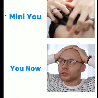 Mini You  VS  You Now

#miniyouvsnow #turkey #hairloss #زراعةالشعر
