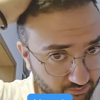 نتيجة 7 أشهر فقط بعد عملية زراعة الشعر 🤩😍