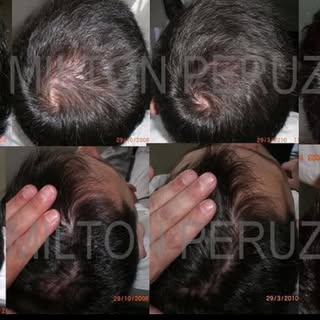 DUTASTERIDA E FINASTERIDA TÓPICAS? MINOXIDIL ORAL E SUBLINGUAL?
Alopecia androgenética é uma condiçã