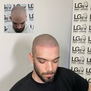 Interesado en Micropigmentación Capilar? 

La mejor solución para la caída del cabello ✔️

Resultado