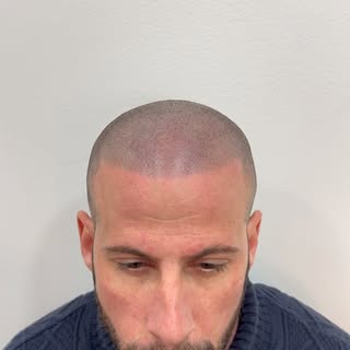 Efecto rapado 🪒 acabado bonito y natural. Caída del cabello? La micropigmentación capilar es la res