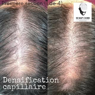 Première session de densification, cliente féminine
.
.
First densification session for  a female cl
