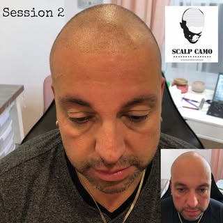#micropigmentation #scalppigmentation #scalpmicro #scalpmicropigmentation #hairtattoo #haircamouflag