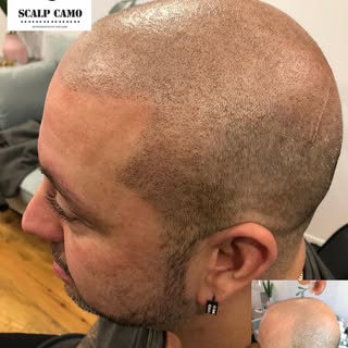 #micropigmentation #scalppigmentation #scalpmicro #scalpmicropigmentation #hairtattoo #haircamouflag