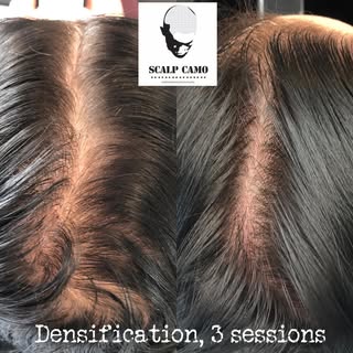 Camouflage de calvitie féminine 

Female hair loss camouflage 

#smp #scalpmicropigmentation #female