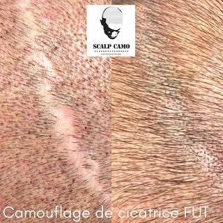 Camouflage de cicatrice suite à une greffe de cheveux de type FUT. 

La photo ‘après’ est immédiatem