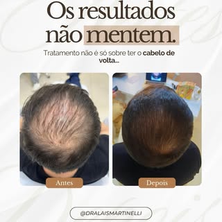 ✨ Não é só sobre cabelo. É sobre se reconhecer de novo! 

A queda capilar vai além da estética.
Ela 