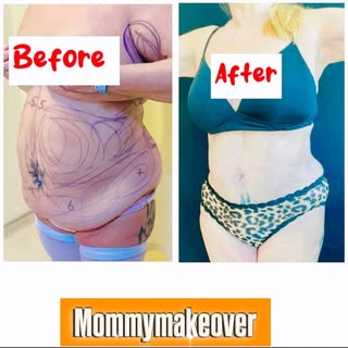 #bahrainbestplasticsurgeon #tummytuck #lipo #bodycontouring #cosmeticsurgery