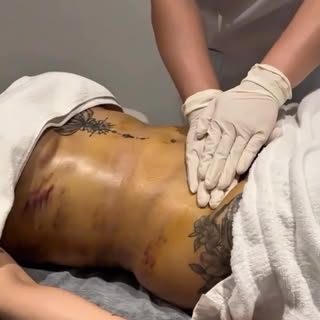 #bahrainbestplasticsurgeon #cosmeticsurgery #liposuction #lymphaticmassage #confidenceboost
