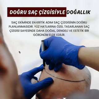 Doğru Saç Çizgisiyle Doğallık!

Saç ekiminde en kritik adım saç çizgisinin doğru planlanmasıdır.Yüz 