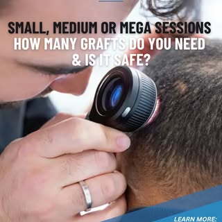 🌟Small, Medium or Mega Sessions: How Many Grafts Do You Need & Is It Safe?🌟

Not all hair transpla