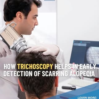 ⭐How Trichoscopy Helps in Early Detection of Scarring Alopecia⭐

In a large, international, multicen