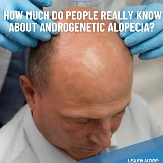 🌟How Much Do People Really Know About Androgenetic Alopecia?🌟

A survey of 553 people revealed sig
