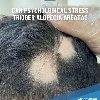 🌟Can Psychological Stress Trigger Alopecia Areata?🌟

The short answer is yes, but not on its own..