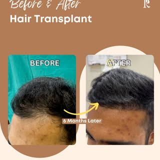 Real progress. Real confidence.

This before & after highlights how a hair transplant can restore na