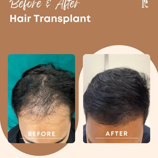 A restored hairline can make all the difference. ✨

From a receding M-shaped hairline to fuller, nat