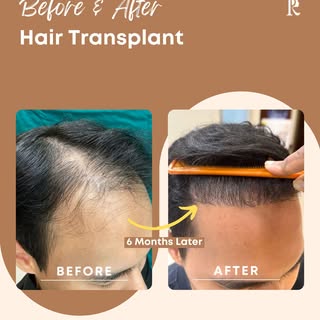From thinning hair to visible improvement. 🌿

Every transformation begins with the right diagnosis,