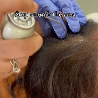 HAIR TRANSPLANT 

If you are experiencing hair loss or hair thinning, there are treatments available