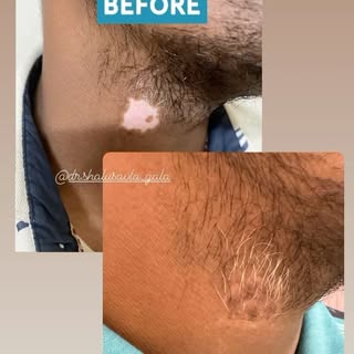 CORN REMOVAL @dr.shalusavla_gala 

#cornremoval #cornprevention #drshalusavla_gala #khar #lowerparel