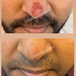 Alopecia Areata before and after @dr.shalusavla_gala 

#drshalusavla_gala #alopeciatreatment #alopec