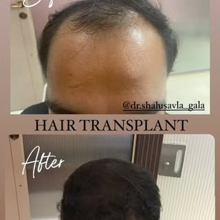 GFC PRP @dr.shalusavla_gala 

#drshalusavla_gala #gfcprphairtreatment #hairlosstreatment #nonsurgica