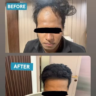 Alopecia Areata before & after @dr.shalusavla_gala 

#alopeciaareata #beforeandafter #intralesionals