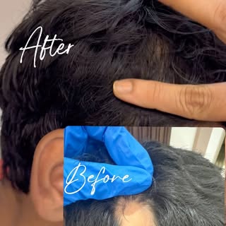 VITILIGO SURGERY 
MINI PUNCH GRAFT SURGERY BEFORE & AFTER 

#drshalusavla_gala #vitiligosurgery #bef