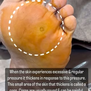 Cyst Removal @dr.shalusavla_gala 

#drshalusavla_gala #cystremovaltreatment #beforeafter #painlessre