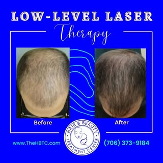 🔥 Don't miss out on the latest hair care and hair loss treatment tips! 🔥

👉 Head over to our YouT