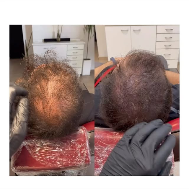 Micropigmentación capilar, efecto mayor densidad sobre cabello largo.