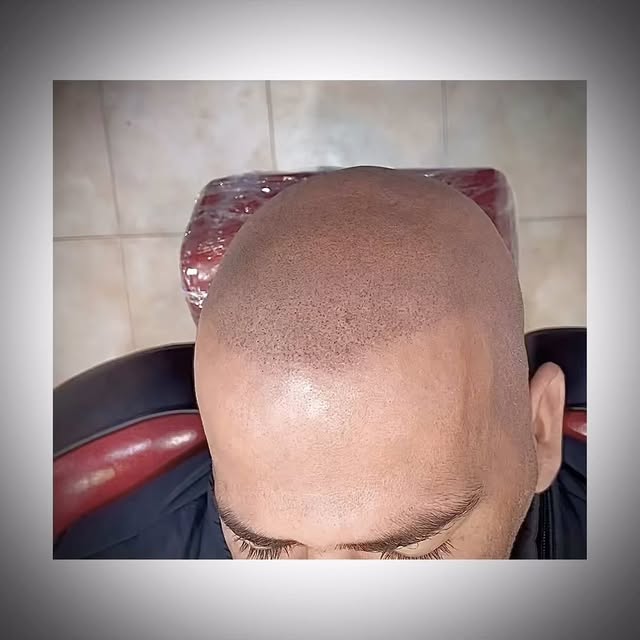 Micropigmentación capilar efecto rapado, trabajo curado.