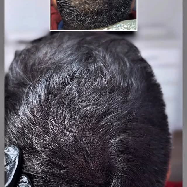 Micropigmentación capilar, efecto mayor densidad