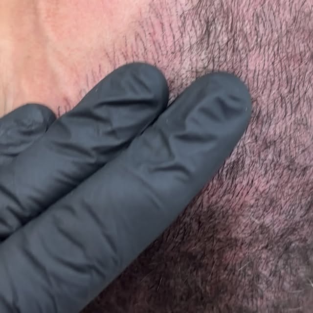 Micropigmentación capilar, simulación de cabellos.