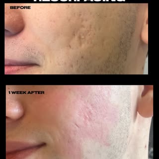 Another reason that lasers are very cool. The ablative fractional laser treated skin had less UV dam