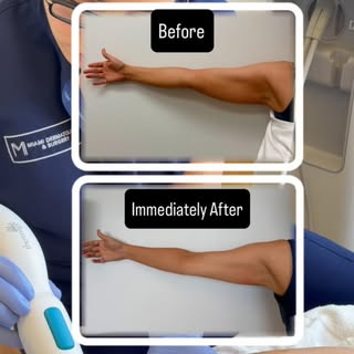 Expert acne scar treatment using multiple lasers (ablative and non ablative) + subcision + Sculptra 