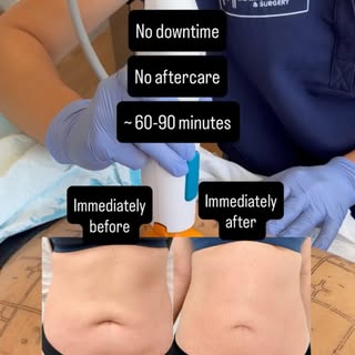 Arm skin tightening - non-invasive edition. This is just 1 treatment. 

In this video, I am performi