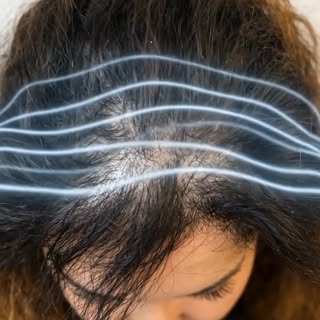 ✨ Rezultati pas 4 muajsh.

Çdo transplantim i flokëve është i personalizuar sipas strukturës së flok