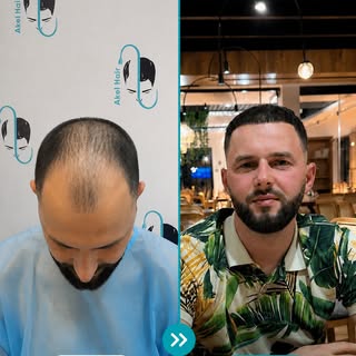 Nga PARA te PAS — një ndryshim që flet vetë.

Me planifikim të saktë, vijë natyrale të flokëve dhe k