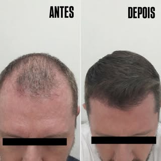 N A T U R A L I D A D E após o transplante capilar.