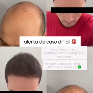 São poucos meses de pós operatório mas que já estão fazendo muita diferença na autoestima do nosso p