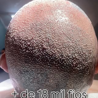 Transplante Capilar FUE em calvicie grau VII