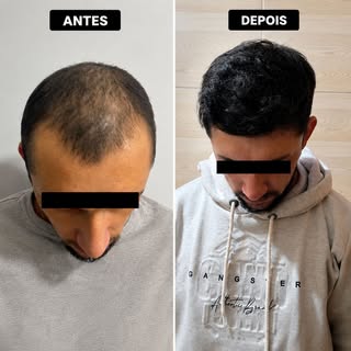 Mais um paciente cabeludo. Com acompanhamento adequado, mesmo pacientes jovens podem realizar o tran