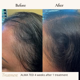 Alma Ted results after 1 treatment 4 weeks later 🤩

📍 190 S Collins Rd. Ste 100, Sunnyvale, TX 751
