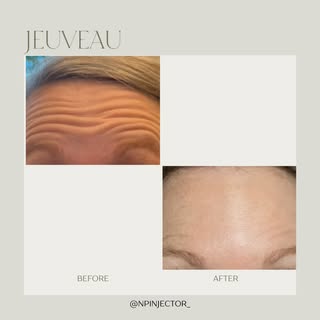 Jeuveau ⭐️

See results as early as 2 days 🤩
Max results 2 weeks 
Helps reduce fine lines and wrink